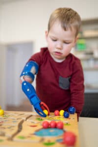 Junge mit Armprothese spielt Geschicklichkeitsspiel mit Bällen